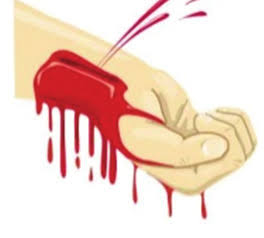 خونریزی شریانی