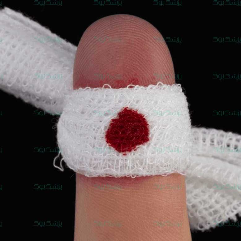 خونریزی مویرگی