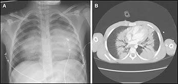 آسیب اندام‌های پرهوا در اثر موج انفجار و فشار شدید