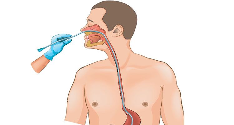 اینفورماتیک تعبیه NG Tube