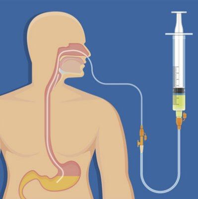 NG Tube و سرنگ گاواژ