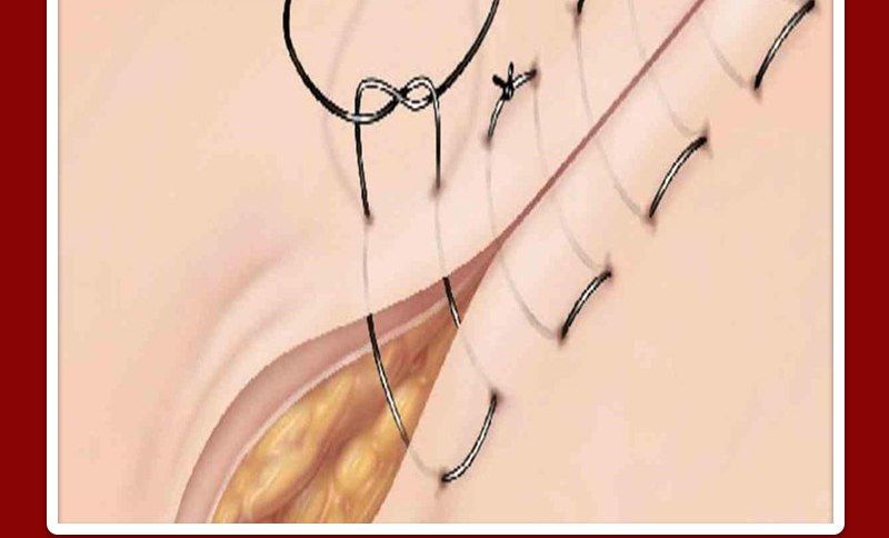 بخیه زدن زخم توسط پرستار در منزل