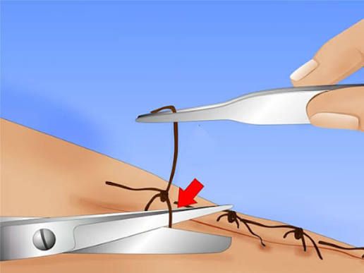 کشیدن بخیه توسط پرستار حرفه‌ای در منزل