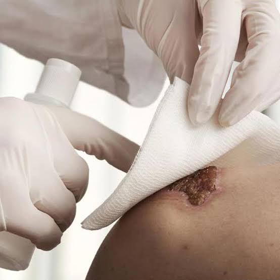 پانسمان زخم بستر