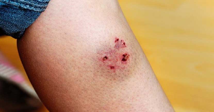 نقاط شایع ورود ترکش و اجسام پرتابی به بدن در شرایط درگیری