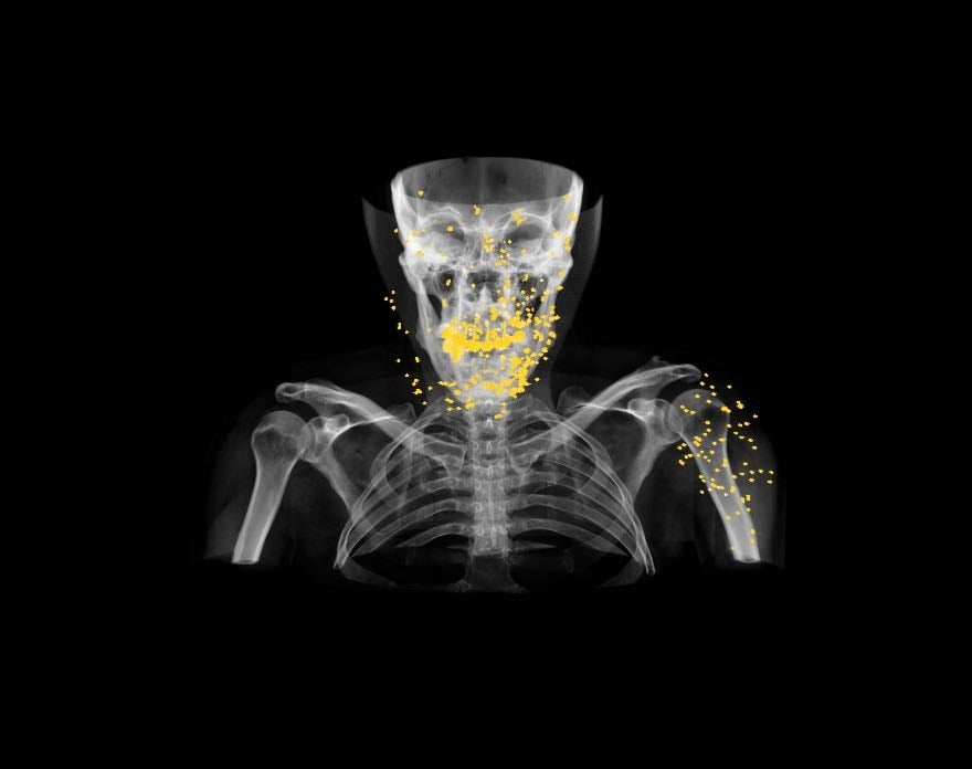 مقایسه ترکش سطحی و ترکش عمیق در آسیب‌های انفجاری